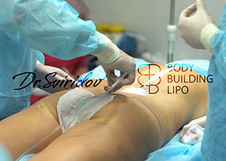 Бодибилдинг липосакция талии, плеч и голеней.