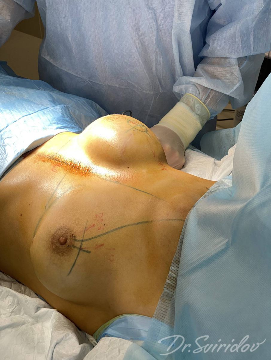 удаление импланта груди у женщин фото 51