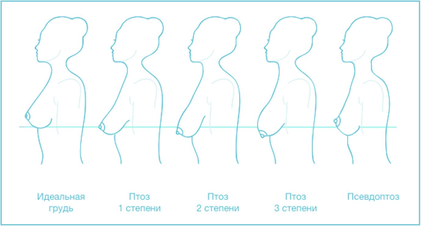 Увеличение груди в Краснодаре - Клиника 