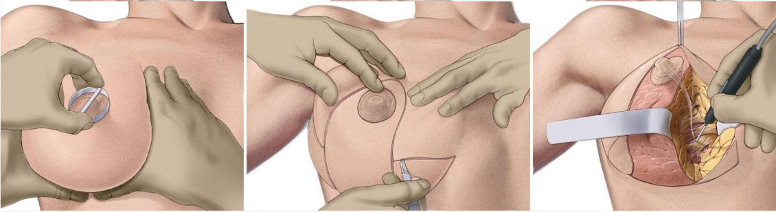 Как проходит операция по Т-образной подтяжке груди.