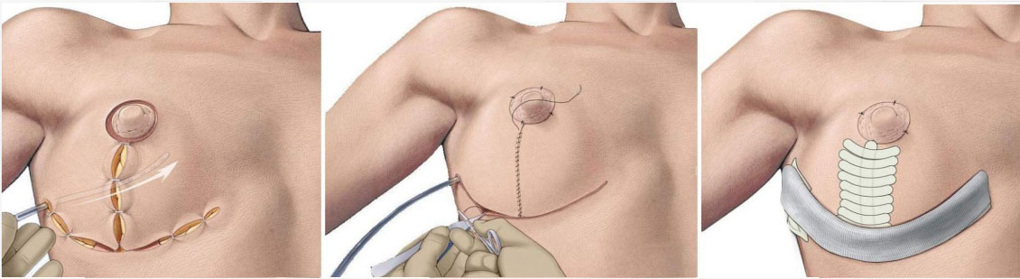 Как проходит операция по Т-образной подтяжке груди.