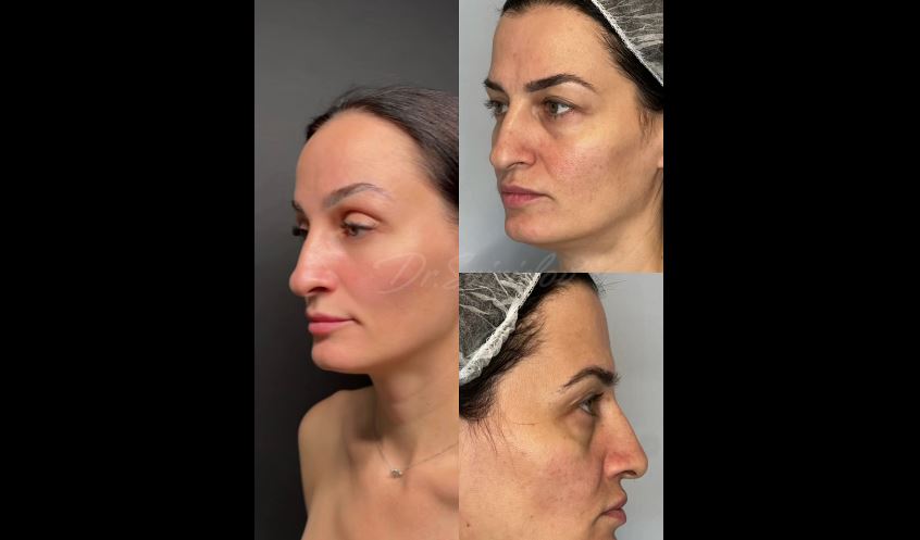 Подтяжка лица