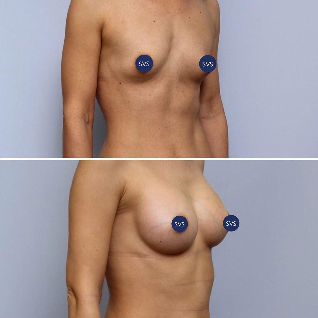 тубулярная форма груди у женщин фото 112