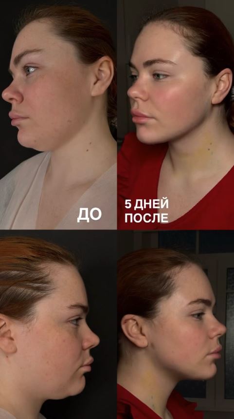 Липосакция второго подбородка