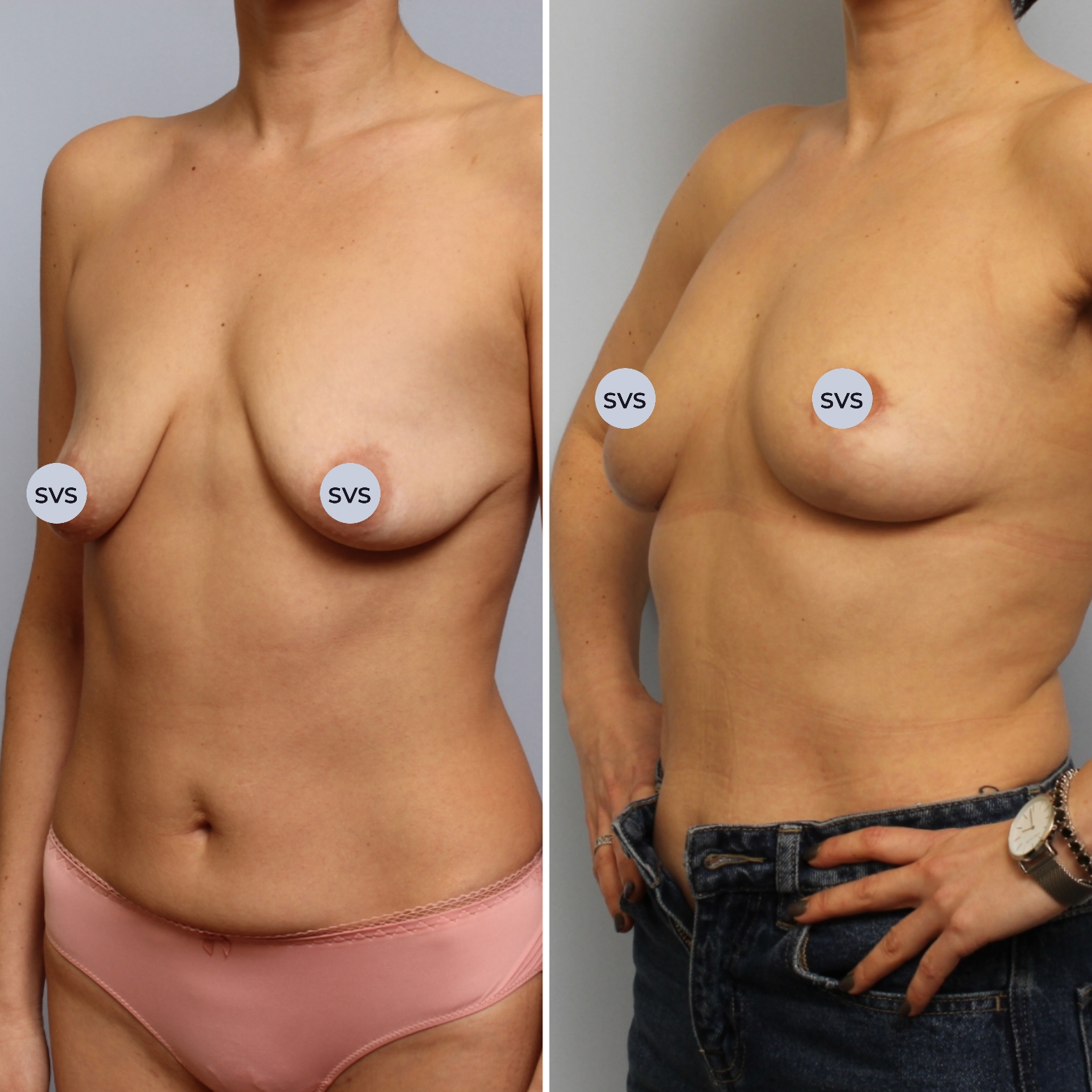 подтяжка груди у женщин фото 95