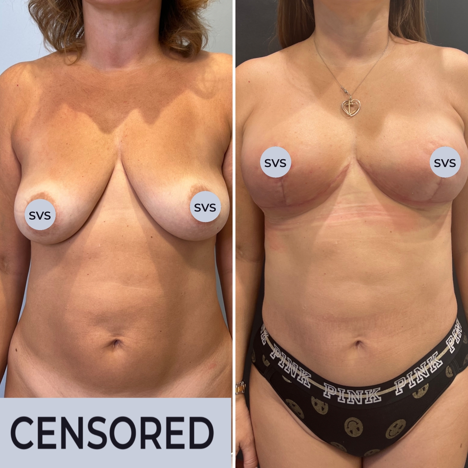 операция по подтяжке груди у женщин фото 39