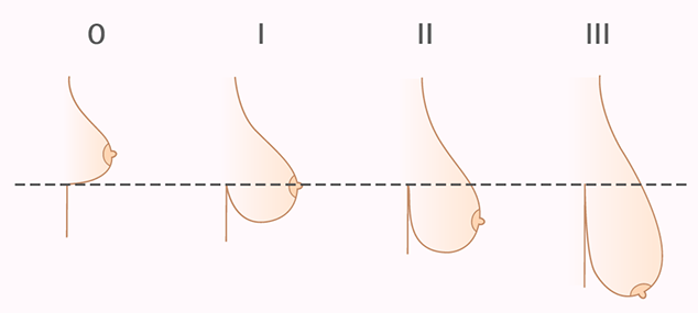 Периареолярная подтяжка молочных желез. Периареолярная подтяжка груди: особенности циркулярной мастопексии