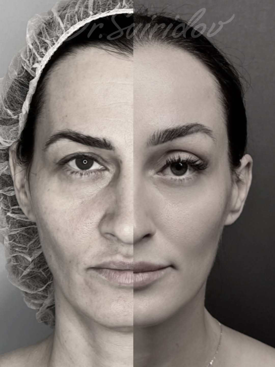 Подтяжка лица