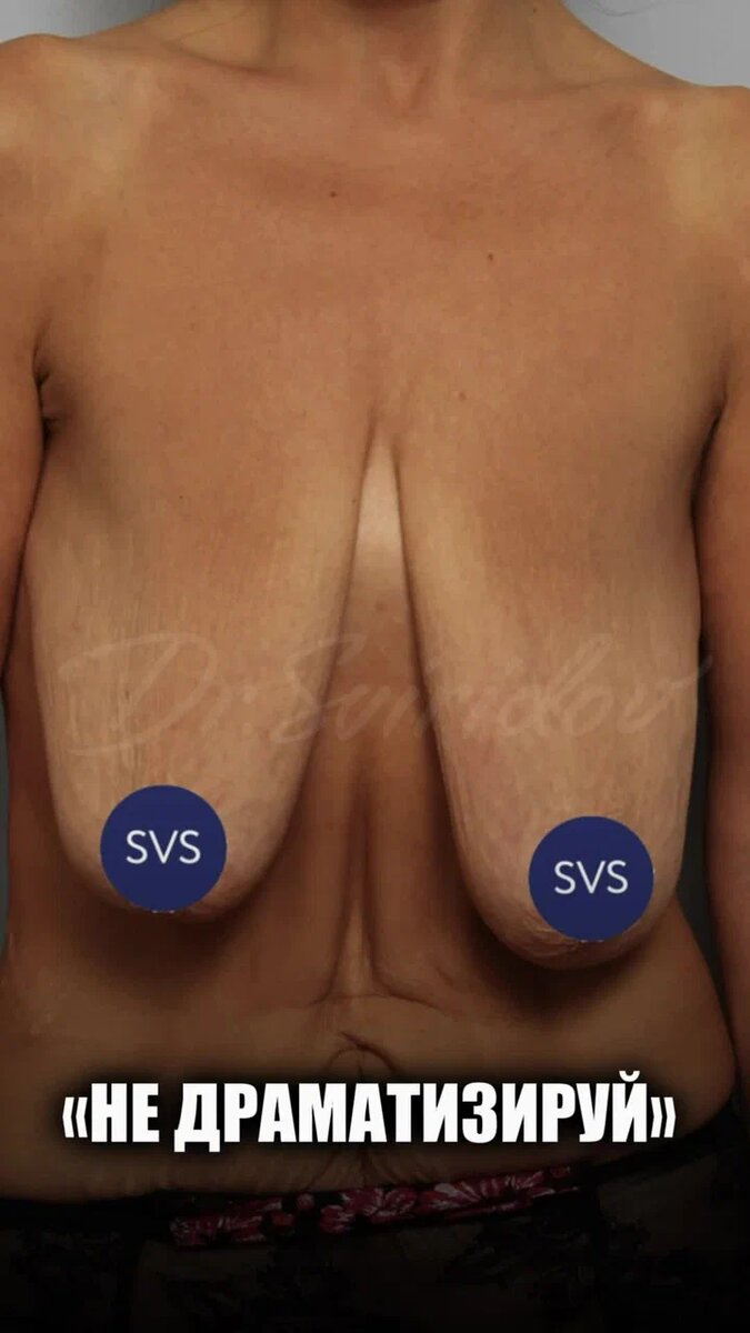 Все еще думайте, что пластика - это каприз? 