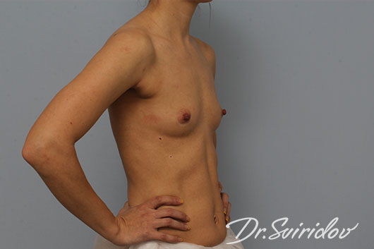 11 месяцев после увеличения груди по бесшовной методике доктора Свиридова патент 2521346 / После