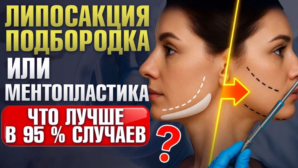 Липосакция подбородка или ментопластика