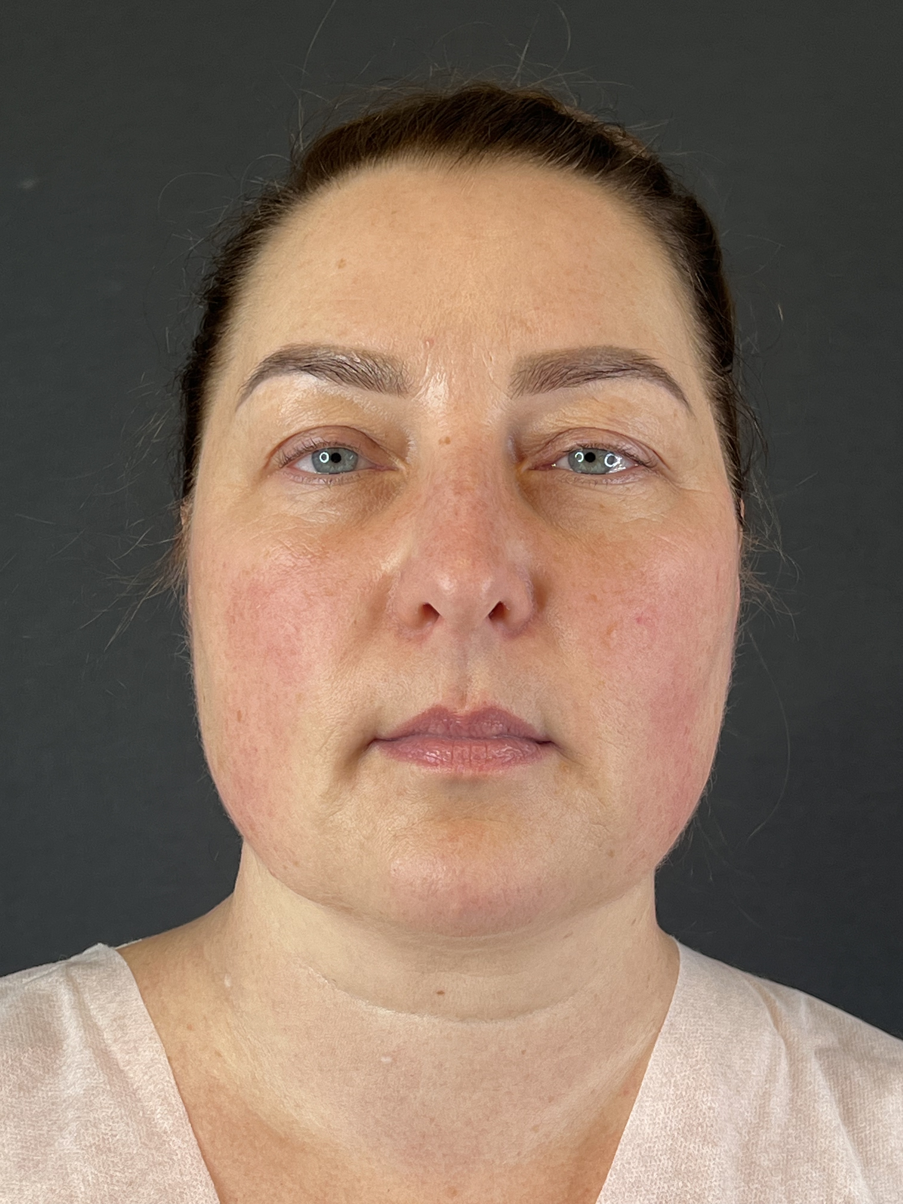 Выполнена блефаропластика. 