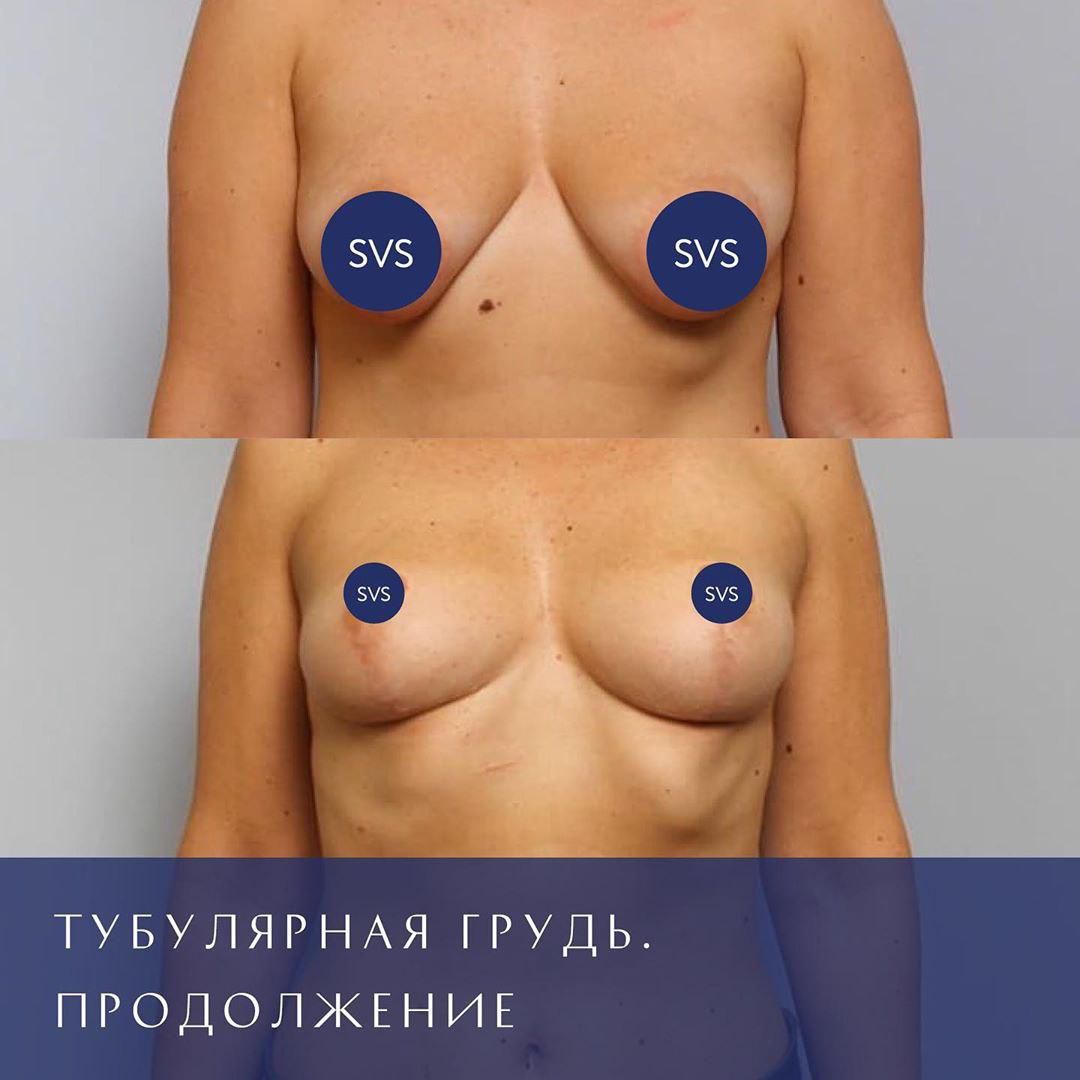 тубулярная форма груди у женщин фото 78