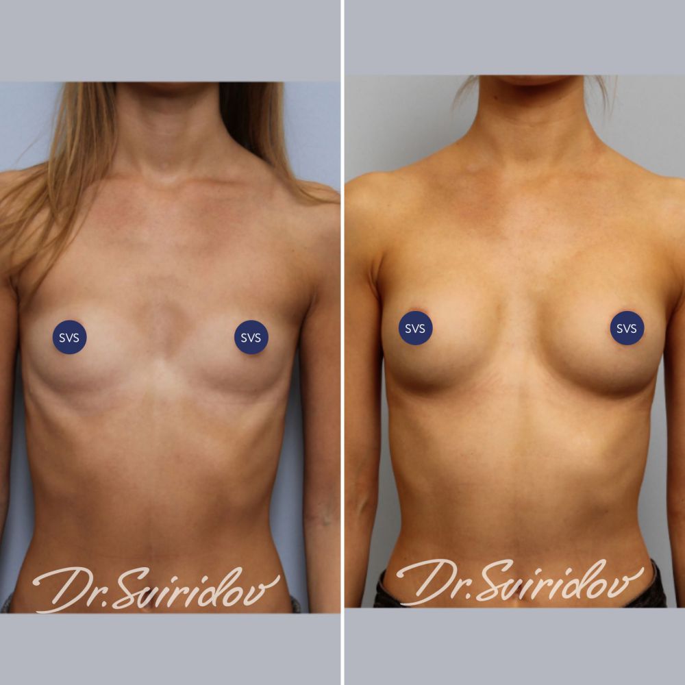разные импланты на одну грудь фото 58