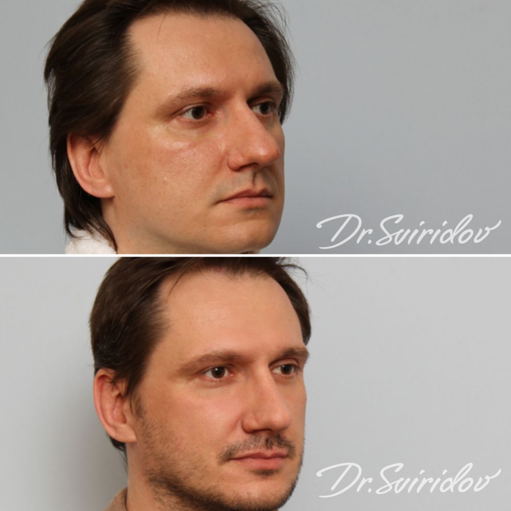 Правда ли, что нос постоянно растет?