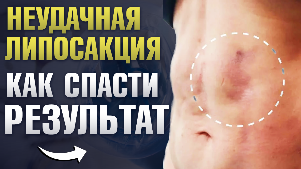 Неудачная липосакция. Как спасти результат