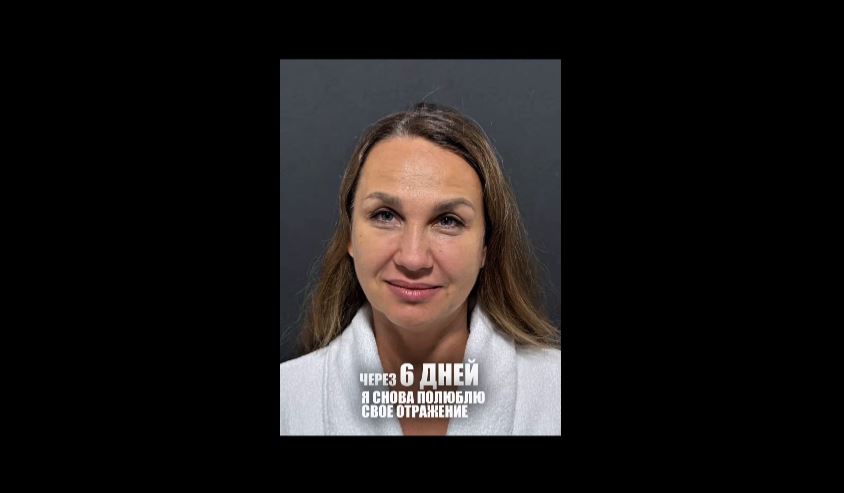 Невидимая подтяжка. 