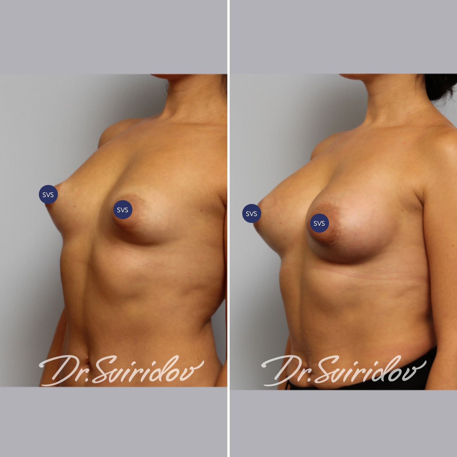 тубулярная деформация груди у женщин фото 51