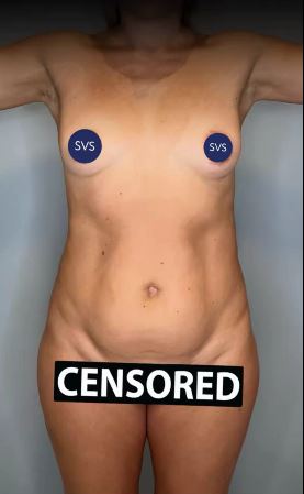 BBLIPO - спортивная липосакция. 