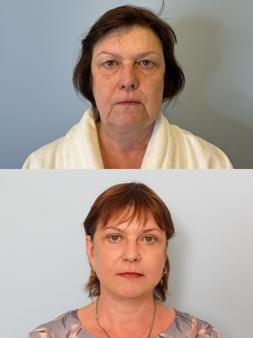 Деформационный тип старения. Сильный птоз тканей