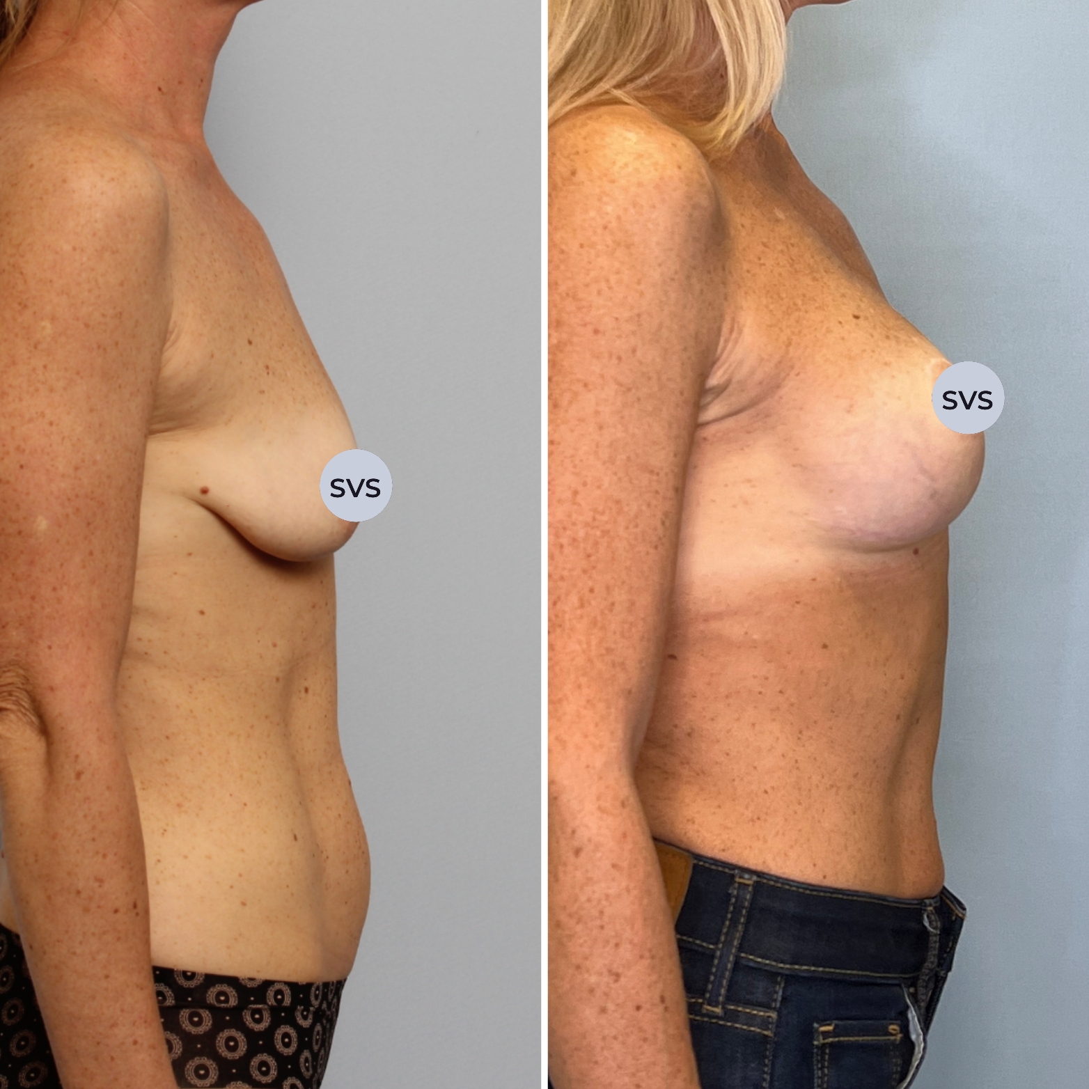 Скоро ли опустится грудь после подтяжки?