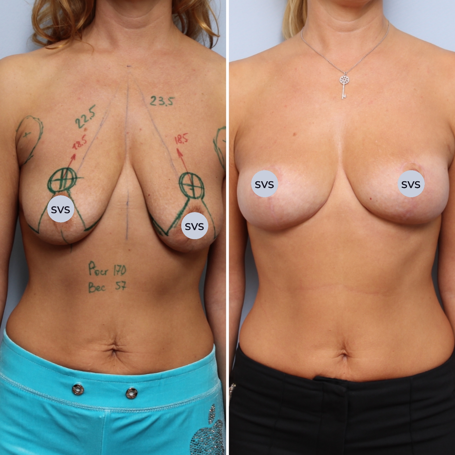 Можно выполнить увеличение груди без установки имплантатов?