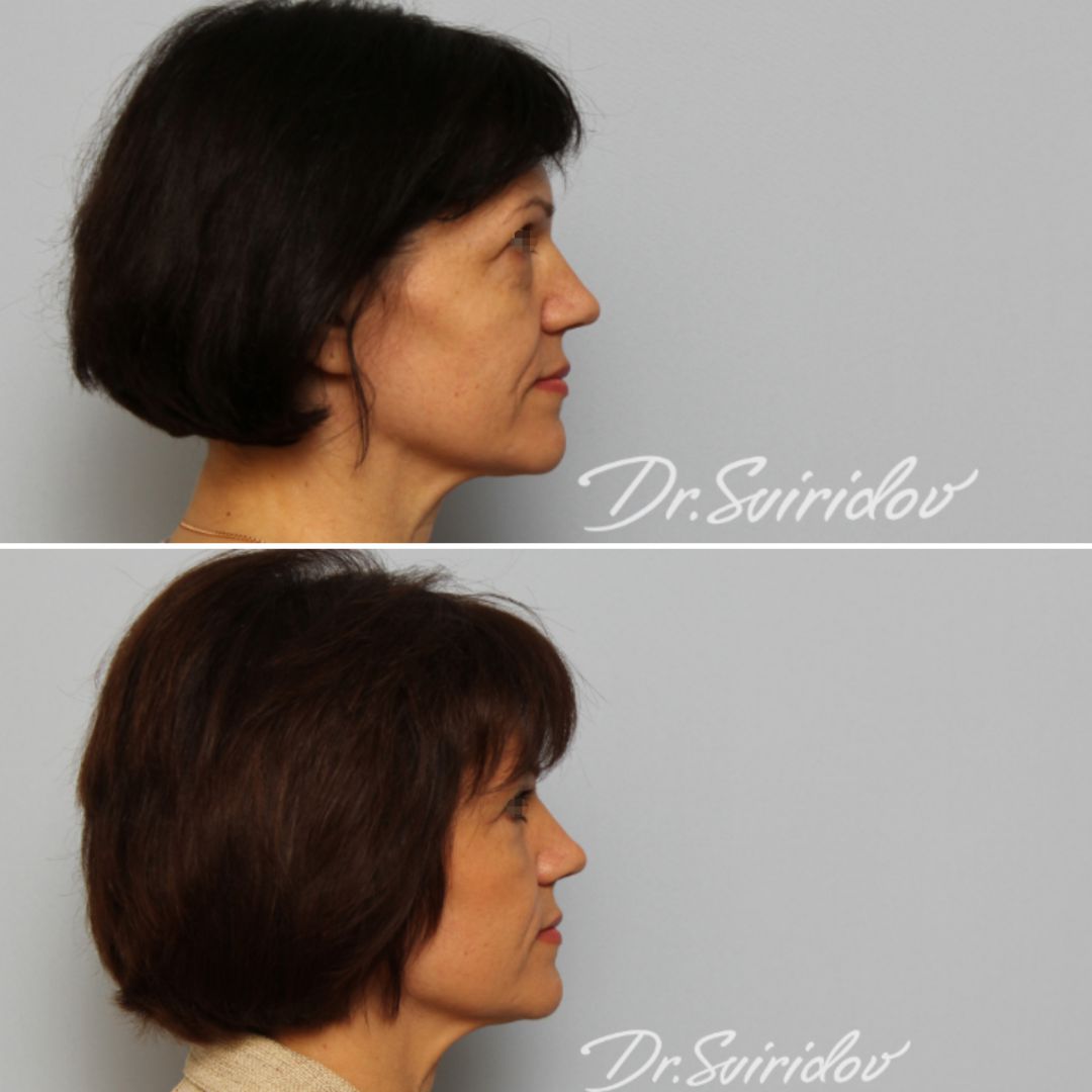 Как избавиться от «мешков» под глазами?