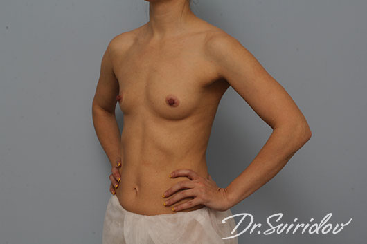 11 месяцев после увеличения груди по бесшовной методике доктора Свиридова патент 2521346 / До