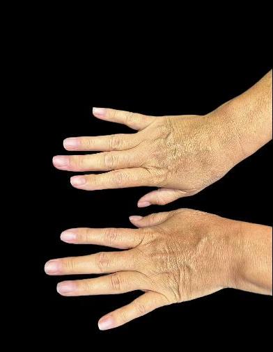 Липофилинг кистей рук