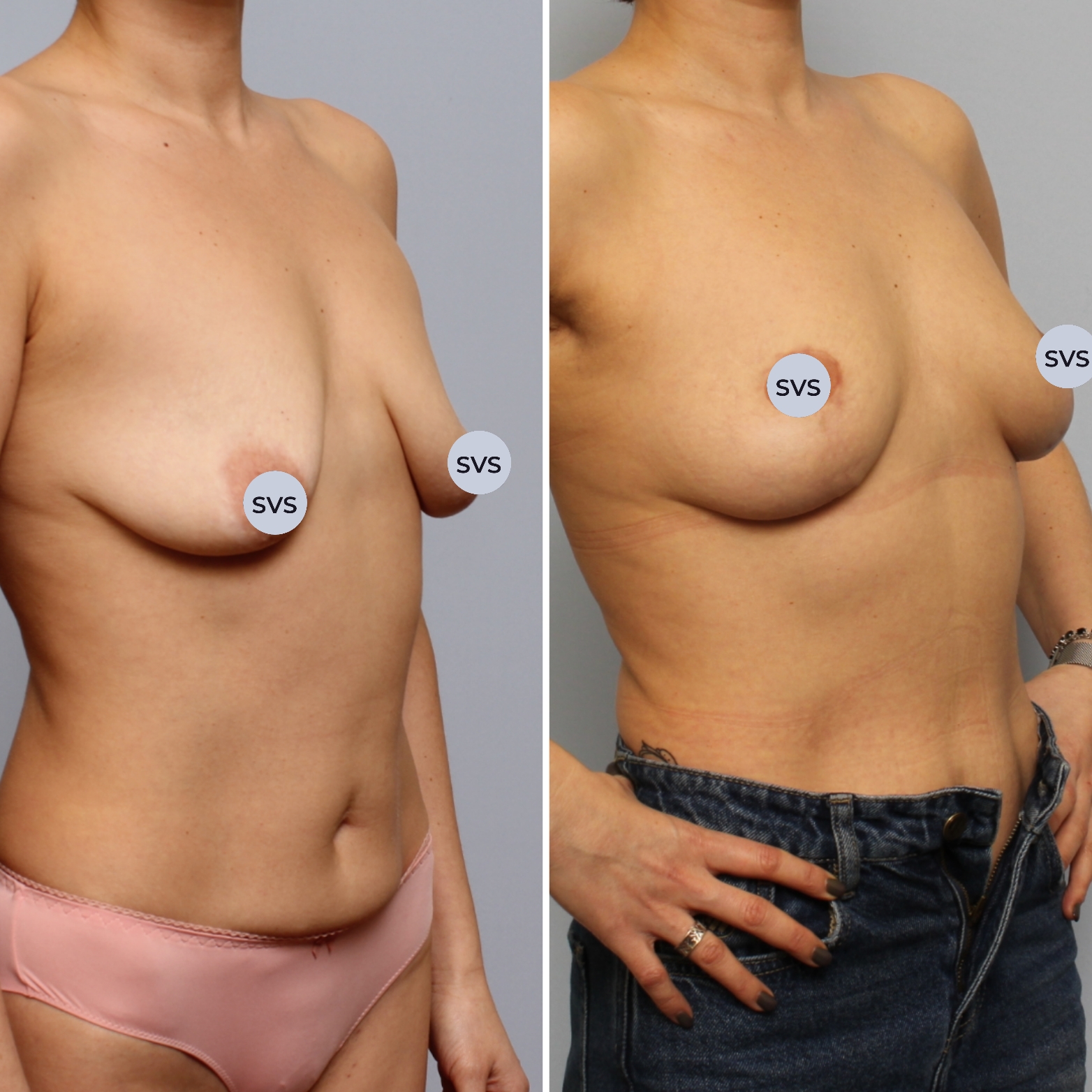 подтяжка груди у женщин фото 38