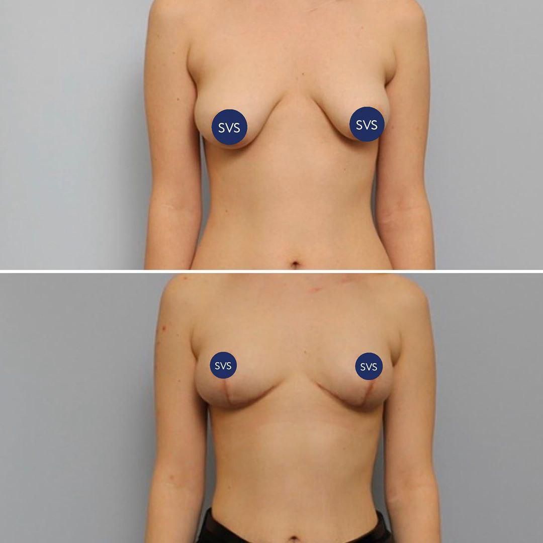 тубулярная деформация груди у женщин фото 110