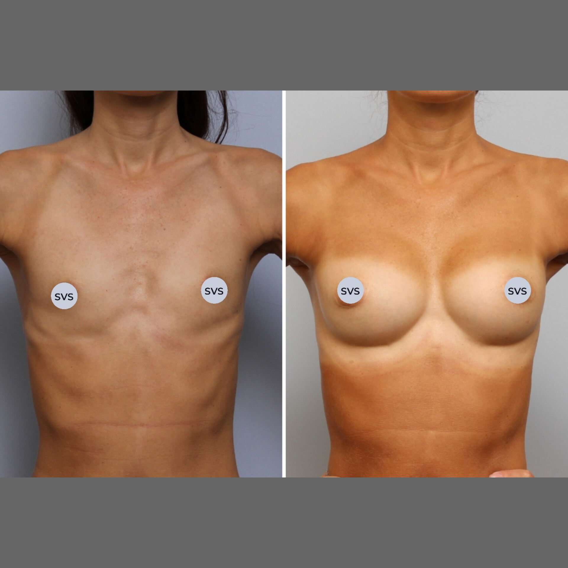 имплант груди размера а фото 28