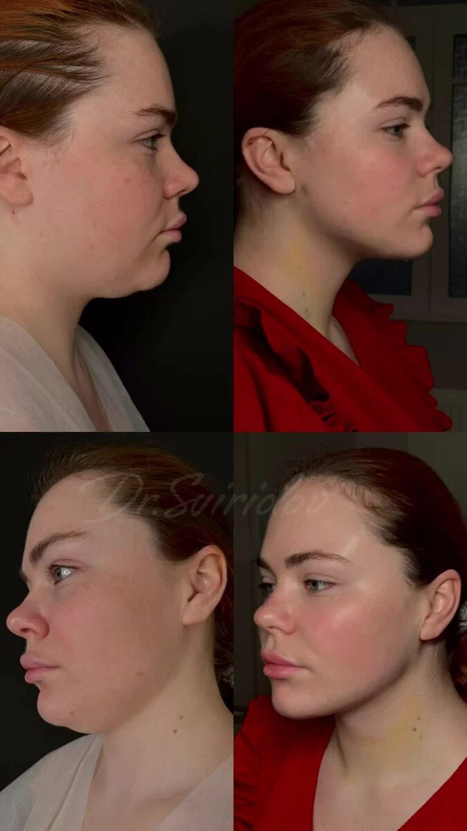 Как и обещал отзыв нашей прекрасной пациентки. На 5 ый день после операции. 