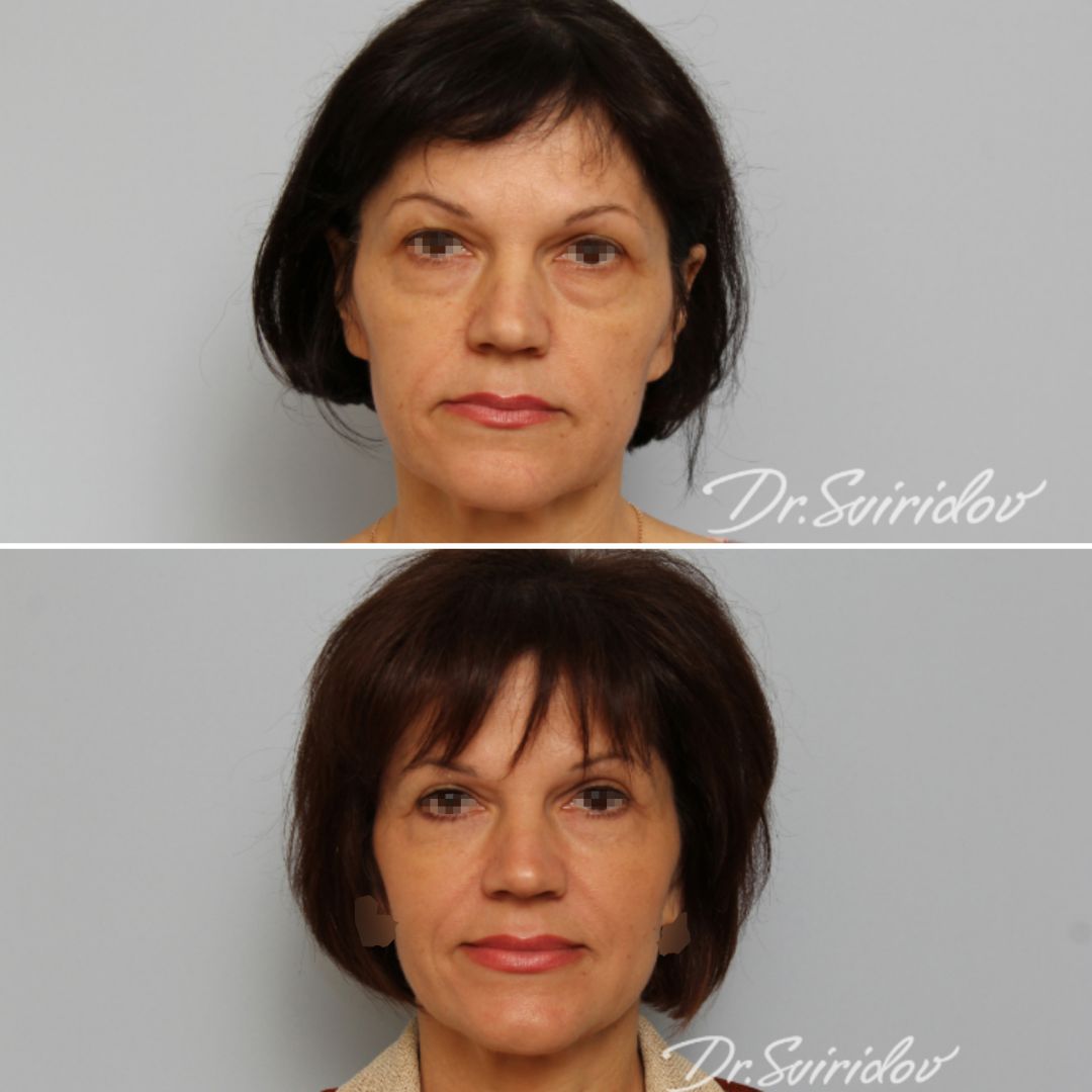 Как избавиться от «мешков» под глазами?