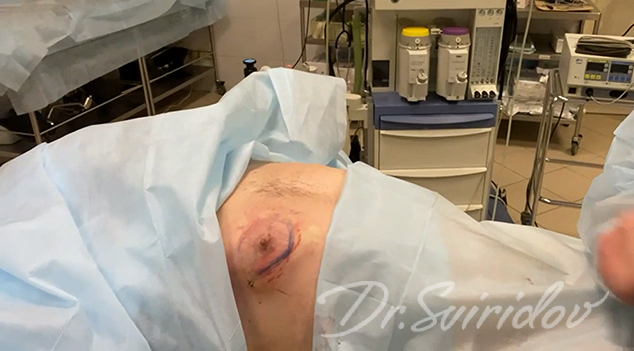 Липосакция для мужчин: Видео до и после операции