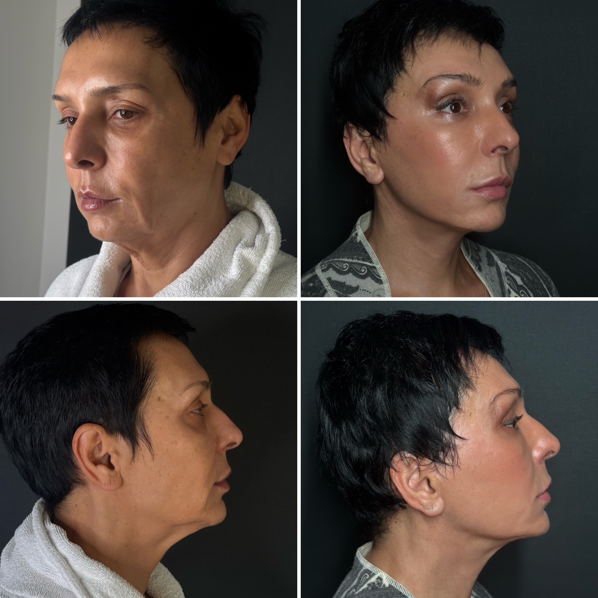 Подтяжка лица по авторской методике. Почему я ее назвал «Невидимая»?