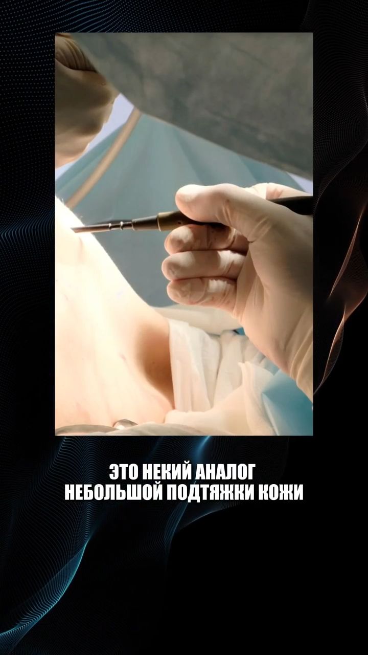 Подтяжка груди без швов: технология и естественный результат