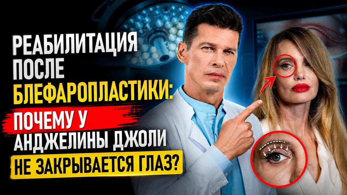 Реабилитация после блефаропластики. Почему у Анджелины Джоли на закрываются глаза