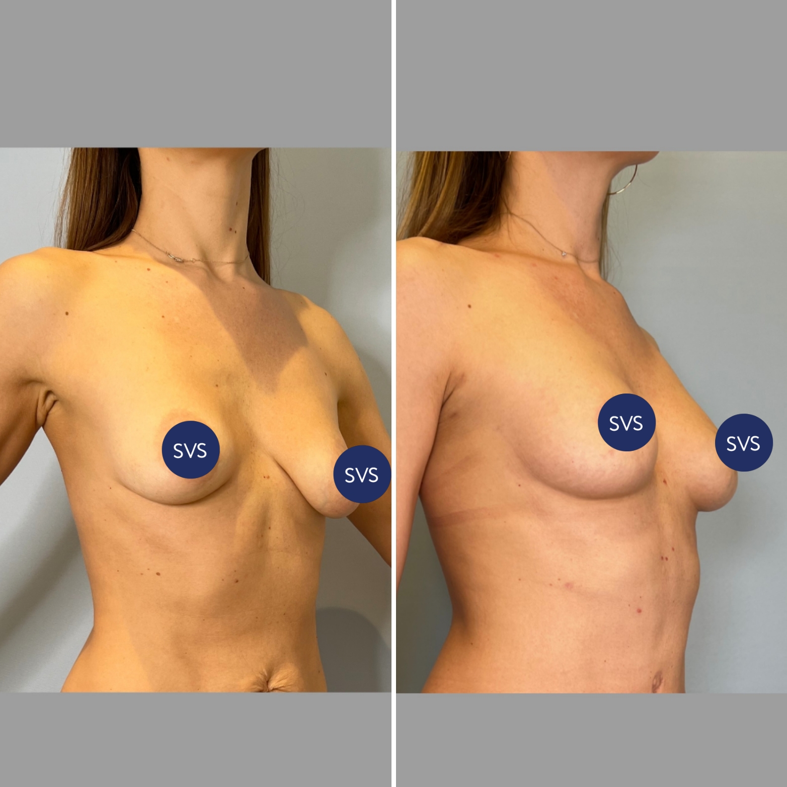 нормальная форма груди у женщин фото 118