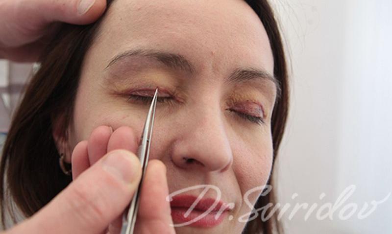 Пластика век (блефаропластика)