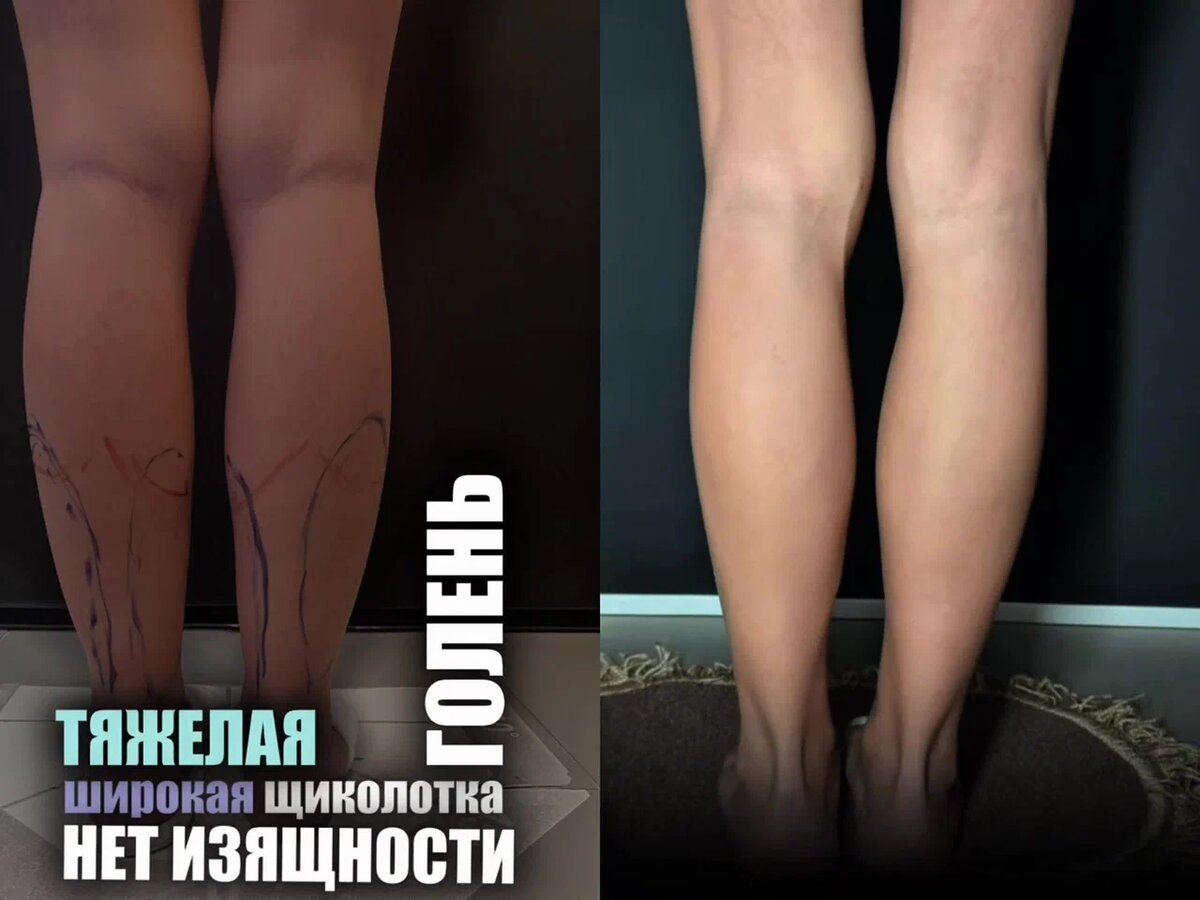 Широкая щиколотка, тяжелая голень, ноги - столбики.