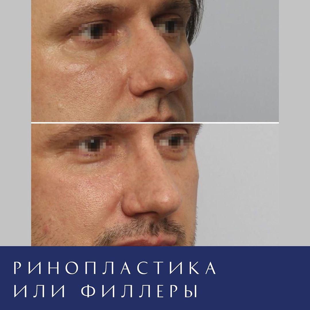 Хотите идеальный нос?