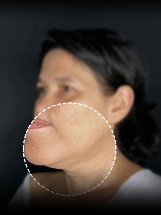 Выполнена СМАС подтяжка и нижняя блефаропластика. 