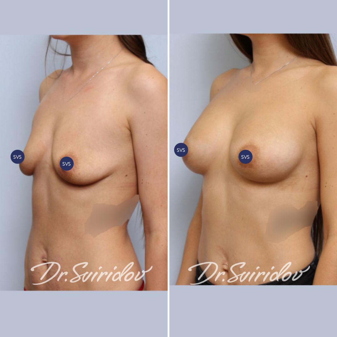 асимметрия груди у женщин форум фото 101