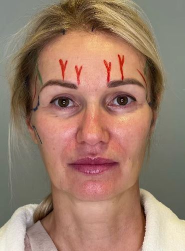 Самый распространенный миф в пластической хирургии, - это изменения лица.