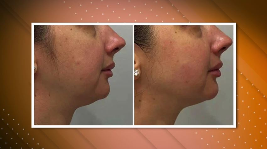 Смас лифтинг