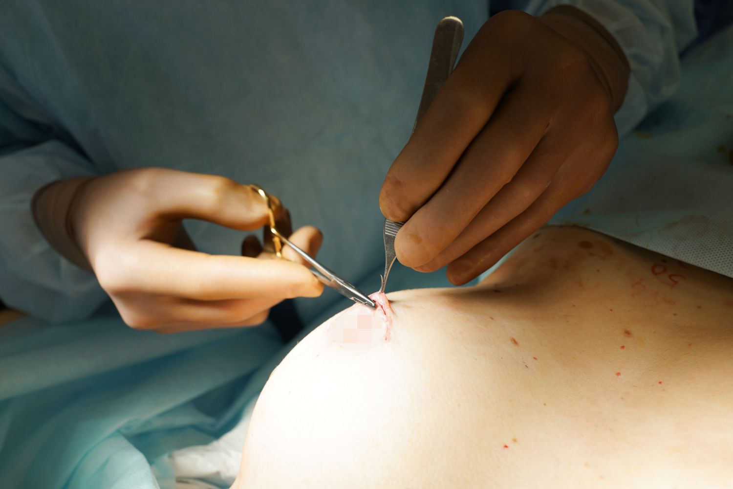 как делают пластическую операцию груди женщин фото 54