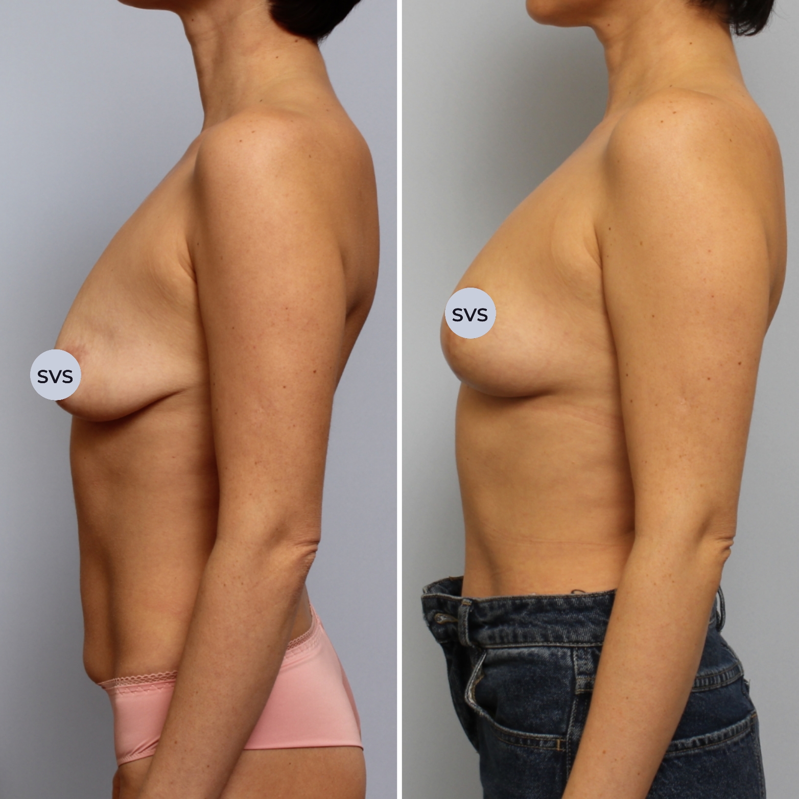 подтяжка груди у женщин фото 118