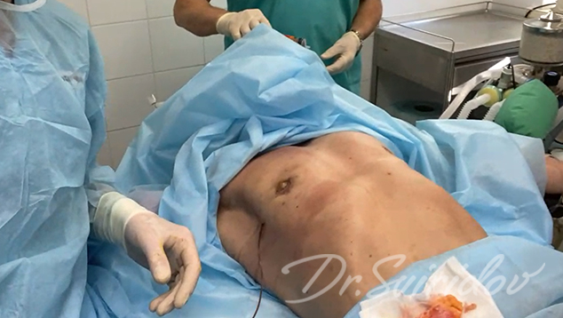Вид гинекомастии сразу после операции.