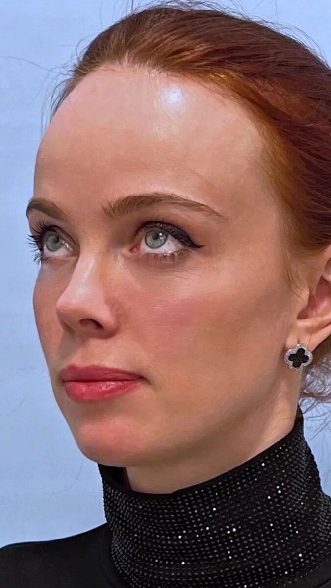 Удаление грыж под глазами: омолаживает, возвращает отдохнувший вид.